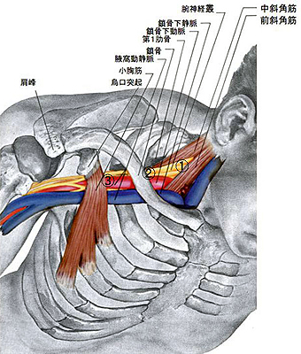 胸郭出口症候群の原因について